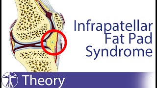 Infrapatellar Fat Pad Syndrome  Hoffas Fat Pad [upl. by Christie]