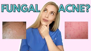 Do YOU have Fungal Acne  Dermatologist Talks Symptoms and Treatments [upl. by Loy547]