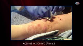 WCW Abscess Incision and Drainage [upl. by Esiuol]