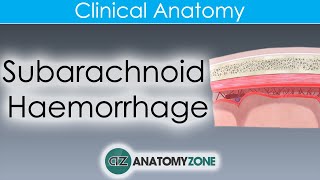 What is Subarachnoid Haemorrhage  Clinical Anatomy [upl. by Ingunna]