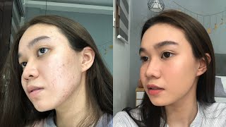 How To Cover Acne MarksPimples with No Foundation  Andy Buela Philippines [upl. by Ise]