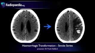 Stroke Haemorrhagic transformation  radiology video tutorial CT MRI [upl. by Marino]