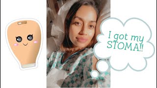 My ILEOSTOMY STOMA SURGERY [upl. by Marguerie440]