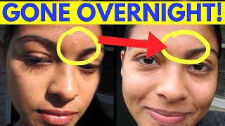 Reduce Pimple Inflammation Overnight [upl. by Wurtz]