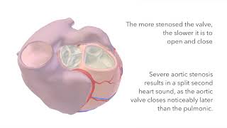 Aortic Stenosis  Murmur Sound amp Animation [upl. by Vallo]