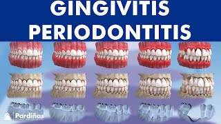 Gingivitis and Periodontitis  Evolution © [upl. by Felton]