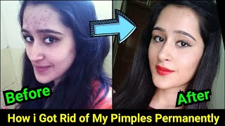 How to Remove Pimples Acne Pimple Marks completely  ThatGlamGirl [upl. by Yila]