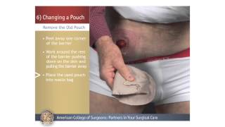 ColostomyIleostomy Changing a Pouch [upl. by Tsenrae]