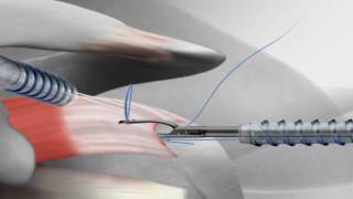 Rotator Cuff Repair with Arthrex® SutureBridge™ [upl. by Tail]