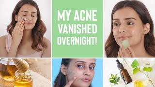 How To Make Your Acne Disappear Overnight  4 Home Remedies For Pimples [upl. by Tedmann]