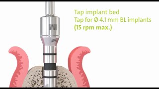 Straumann® PURE Ceramic Implant Monotype Step by Step [upl. by Nrev]