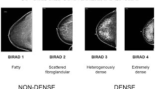 Dense Breast Tissue Breakthrough Technology  Dr Don Wells [upl. by Jolyn]