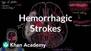 Hemorrhagic strokes  Circulatory System and Disease  NCLEXRN  Khan Academy [upl. by Salokin]