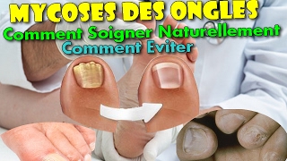 Mycoses des Ongles  Comment Soigner Naturellement amp Comment léviter [upl. by Molton]