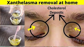 Xanthelasma removal at home  Home remedy to get rid of cholesterol deposits around your eyes natura [upl. by Nerrej]