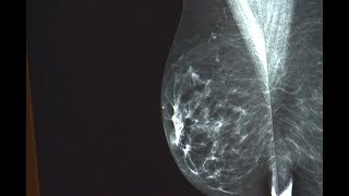 Breast Density Category C or D [upl. by Sanyu]