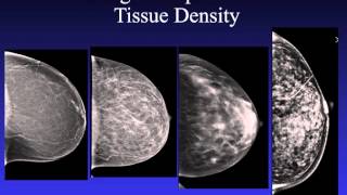 Introduction to Mammography [upl. by Wright]