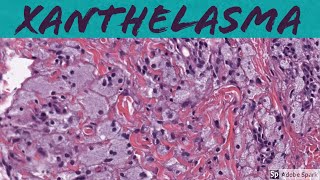 Xanthelasma Xanthoma of Eyelid 5Minute Pathology Pearls [upl. by Nerreg706]