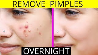 How To Remove Pimples Overnight  Acne Treatment  Anaysa [upl. by Lleira167]