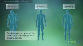 Spinal Deformities Symptoms [upl. by Ecienal]