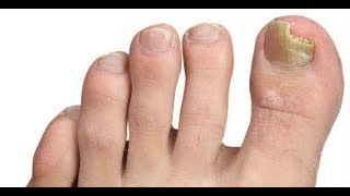 Comment prévenir les mycoses des ongles de pieds [upl. by Yran]