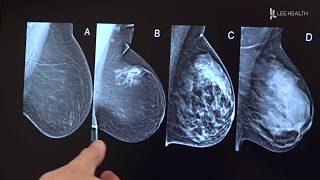 New Guidelines for Mammograms [upl. by Meilen]