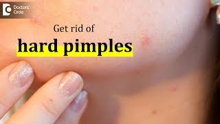 How to get rid of hard pimples  Dr Urmila Nischal [upl. by Anilra]