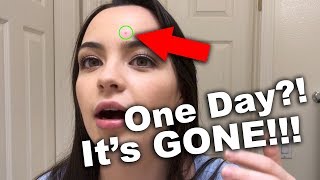 How I got rid of a PIMPLE in ONE DAY WARNING kind of gross [upl. by Morra]